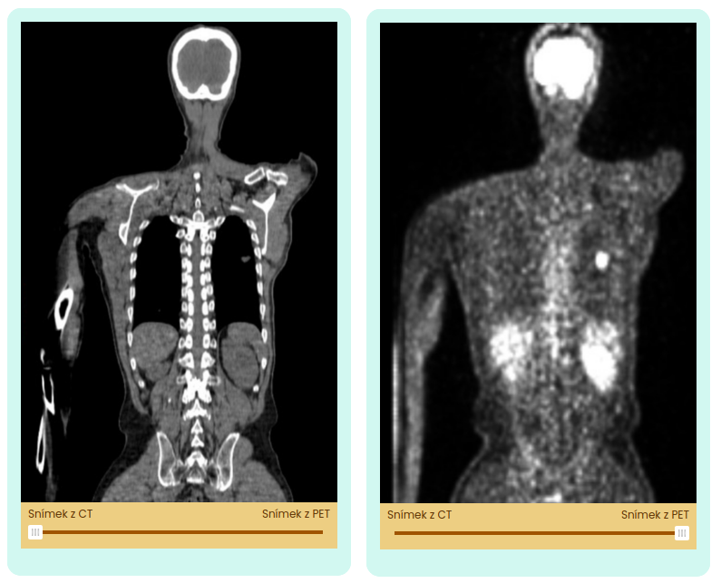 An example of interactive slider element – student can use the slider to see differences between CT (computed tomography) image and PET (positron emission tomography) image and to see their fusion (when move slider to in between positions). © SÚRO